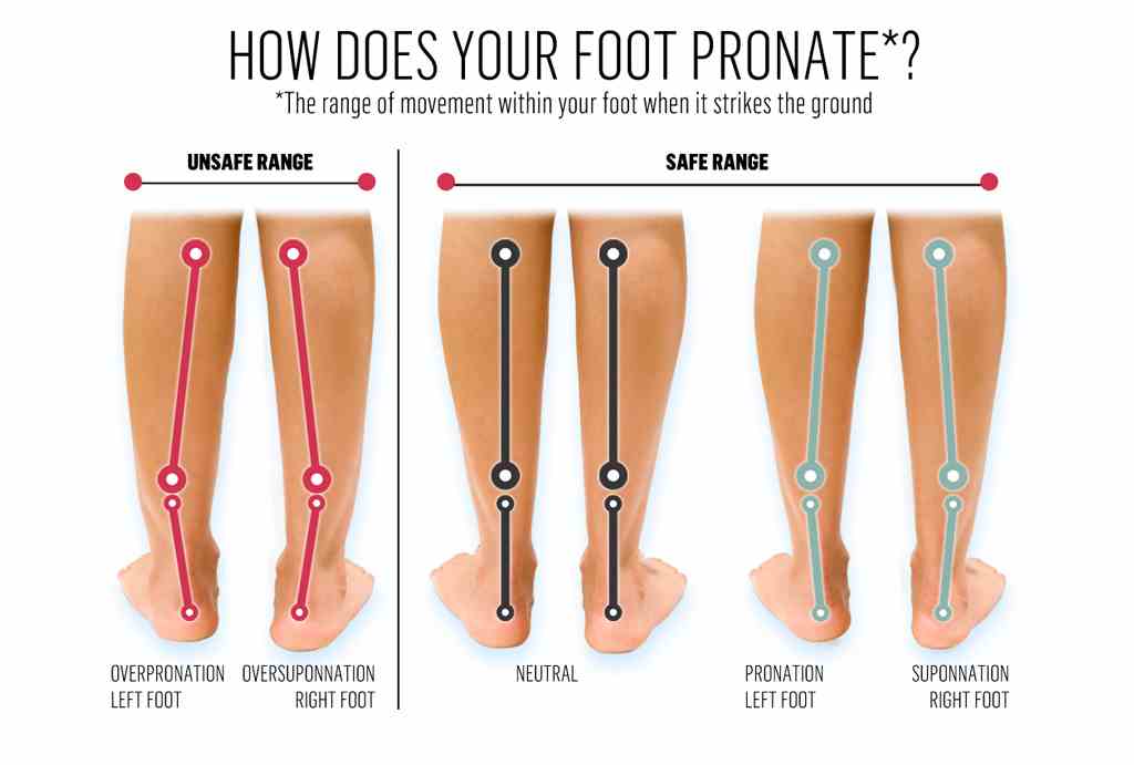 Cause of child foot pronation and supination