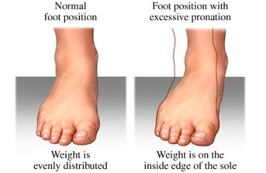 Children and ankles turning inwards 