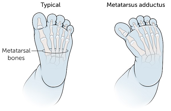 Toddler foot and pigeon toe metatarsus adductus