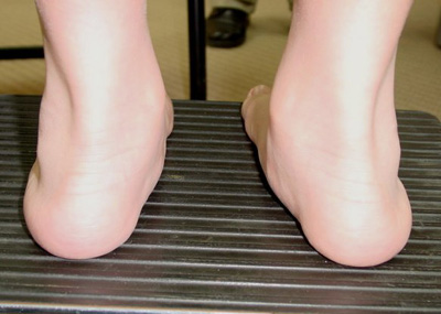 Causes of kids ankle pronation